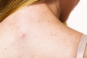 Monsoon infections मानसून में स्किन इंफेक्शन बरसात में त्वचा की समस्या Monsoon skin problems